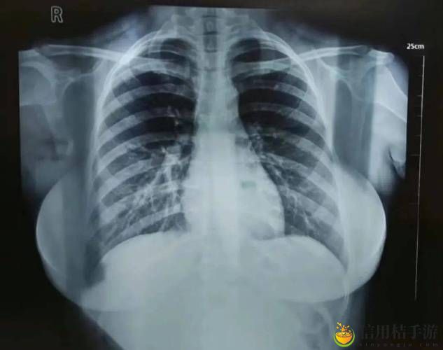 100%胸片曝光率图片女生:揭示影像背后的真实故事